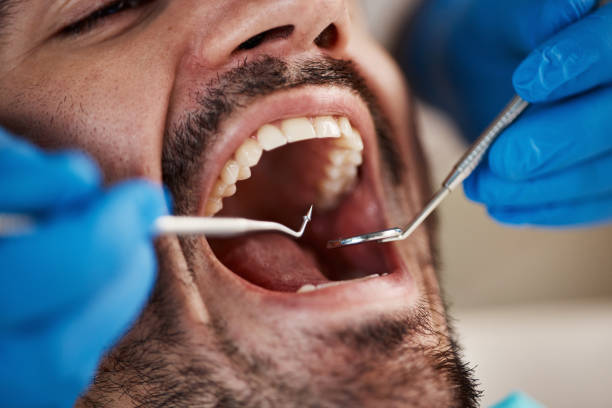 Best Emergency Dentist for Lost Fillings or Crowns in Towanda, KS